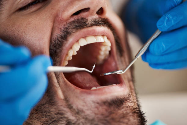 Teeth Whitening in MI